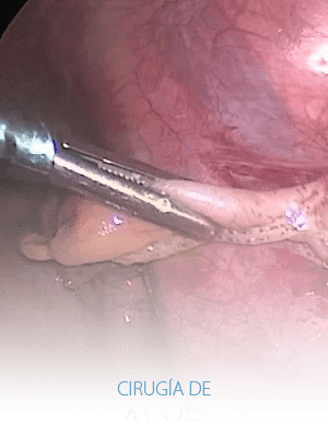 Cirugía y endoscopia en México apendice